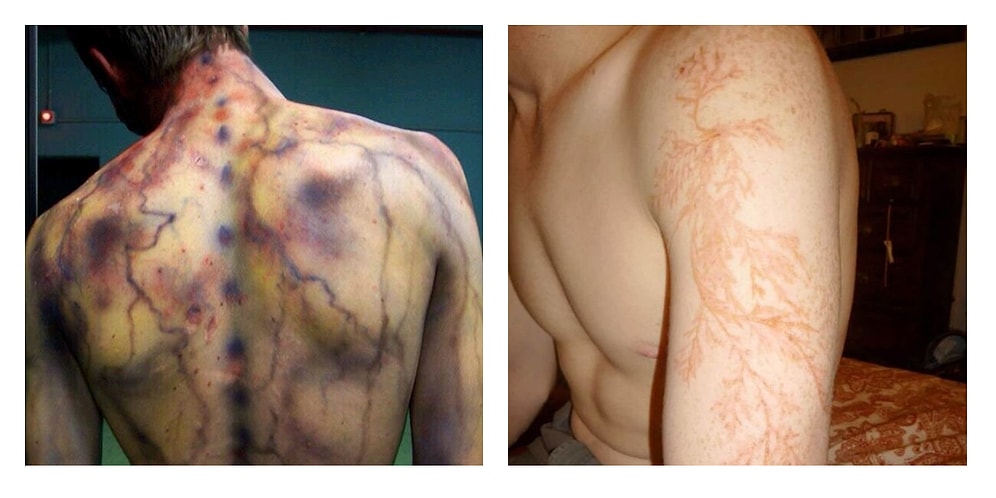 Природа не шутит: Вот как выглядит тело человека после удара молнии