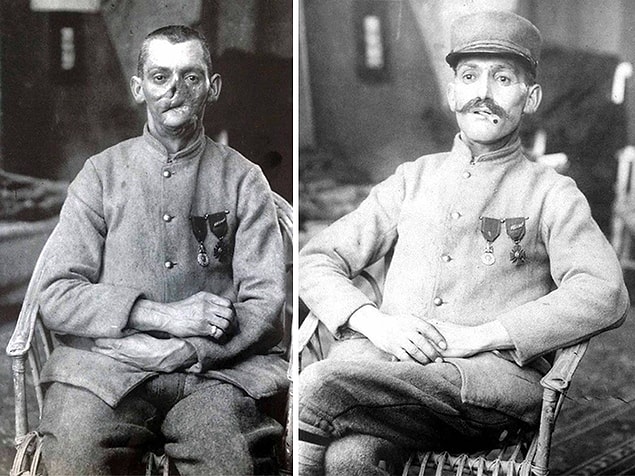 Bu insanlardan bazıları o kadar büyük yaralar almışlardı ki yüzleri neredeyse tanınmaz haldeydi.