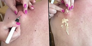 İzlemekten Keyif Alanlara Pek de Hijyenik Olmayan Şekilde Devasa Kist Sıktırma Videosu!