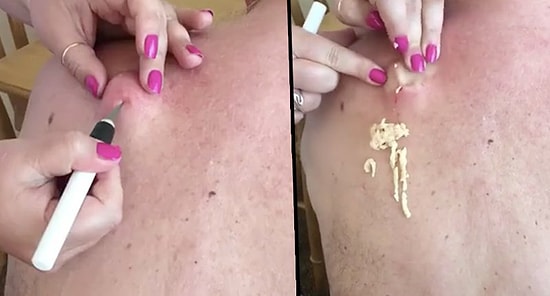 İzlemekten Keyif Alanlara Pek de Hijyenik Olmayan Şekilde Devasa Kist Sıktırma Videosu!