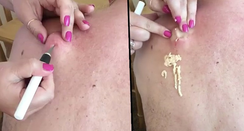 İzlemekten Keyif Alanlara Pek de Hijyenik Olmayan Şekilde Devasa Kist Sıktırma Videosu!