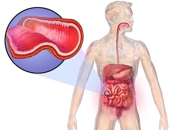 6. Kanlı dışkılama her zaman kötüye işarettir ve birçok farklı anlam ifade edebilir. Bunlardan biri de Crohn's hastalığı.