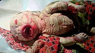 Deforme Kol ve Bacaklar, Pul Pul Dökülen Bir Deri... Doğduğu Andan İtibaren İnsanı Acılarla Sınayan Palyaço Bebek Hastalığı