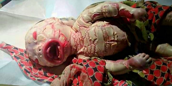 Deforme Kol ve Bacaklar, Pul Pul Dökülen Bir Deri... Doğduğu Andan İtibaren İnsanı Acılarla Sınayan Palyaço Bebek Hastalığı
