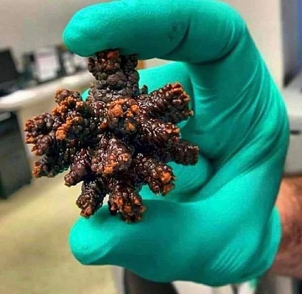 12. Mesaneden alınan böbrek taşı: