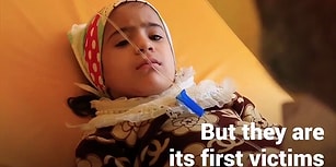 Kıtlığın Eşiğine Gelen Yemen'de Yüz Binlerce Çocuk Ölümle Burun Buruna Yaşıyor!