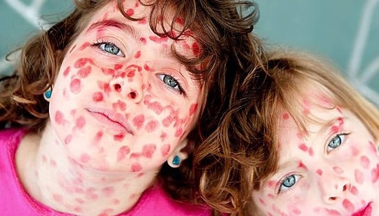 Эпидемия кори на пути к России: более 41 тыс. случаев заболевания в Европе, лидирует Украина