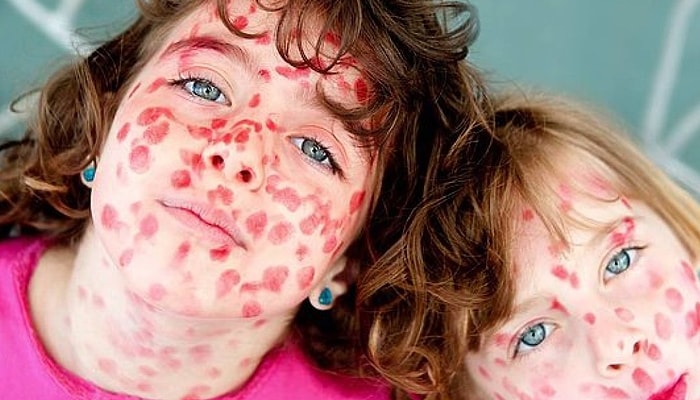 Эпидемия кори на пути к России: более 41 тыс. случаев заболевания в Европе, лидирует Украина