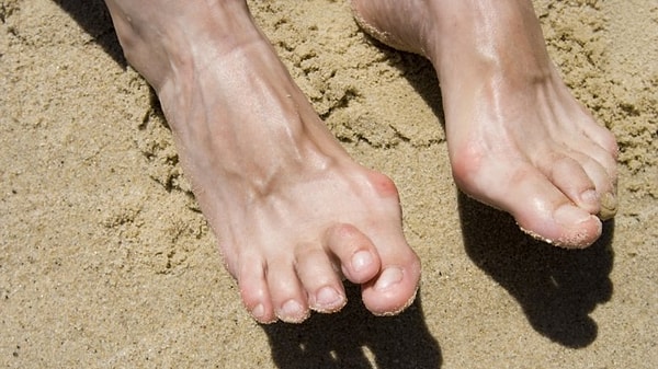 5. Уменьшится развитие вальгусных деформаций