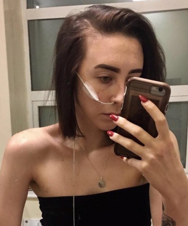 4. Эмили установили назогастральный зонд и кормили через него. Она отправила другу это фото с подписью: «Я уже такая огромная, зачем она заставляют меня есть больше».