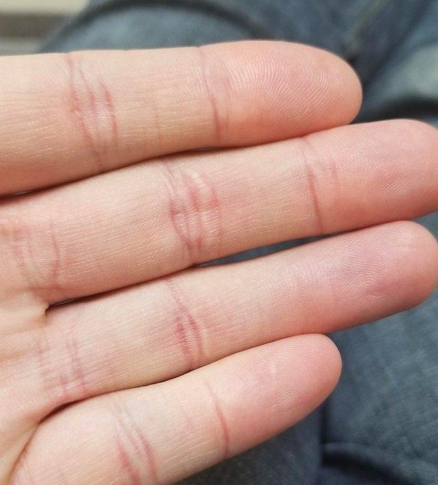 5. "4 ay eklemim fonksiyonsuz kalınca parmak çizgim kayboldu."