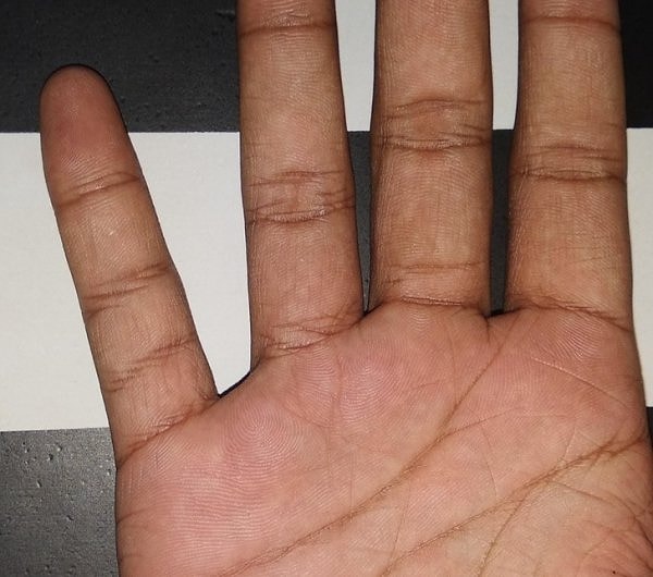 13. "На мизинце одной из моих рук четыре фаланги вместо трёх"