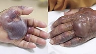 Suşi Yediği İçin Kaptığı Enfeksiyon Sonucu Kangren Olup Kolu Kesilen Yaşlı Adam