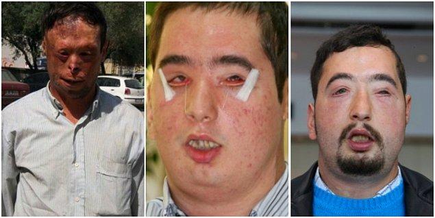 3. 3,5 yaşında ocağa düşmesi sonucu yüzünün yanmasıyla hayatı değişen Turan Çolak.