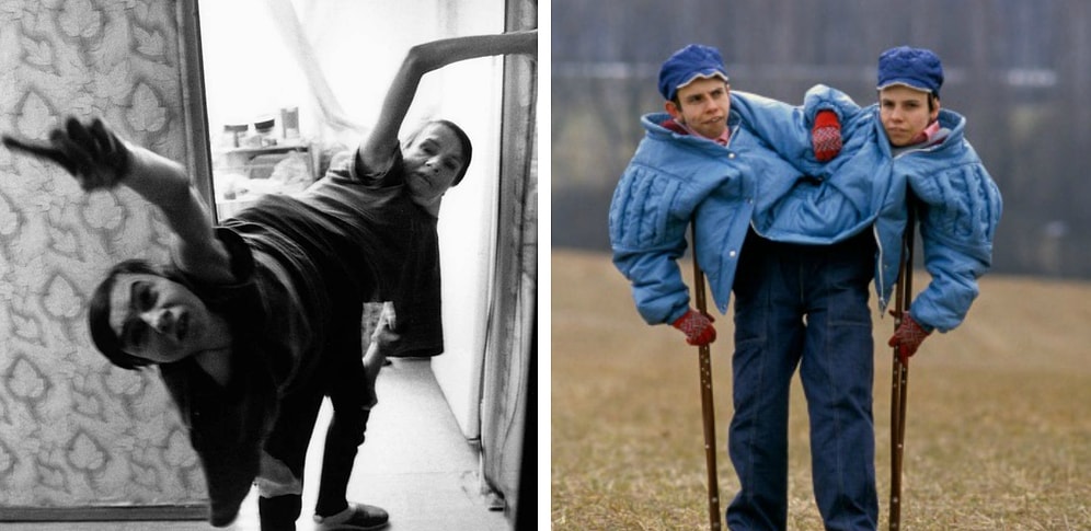 Одна психопатка, другая — эмпат: чудовищные эксперименты СССР над сиамскими близнецами Дашей и Машей