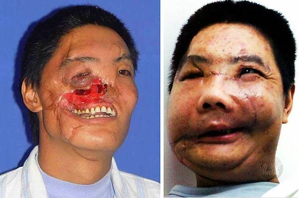 14. Ayı saldırısı sonucunda yüzü parçalanan Li Guoxing.