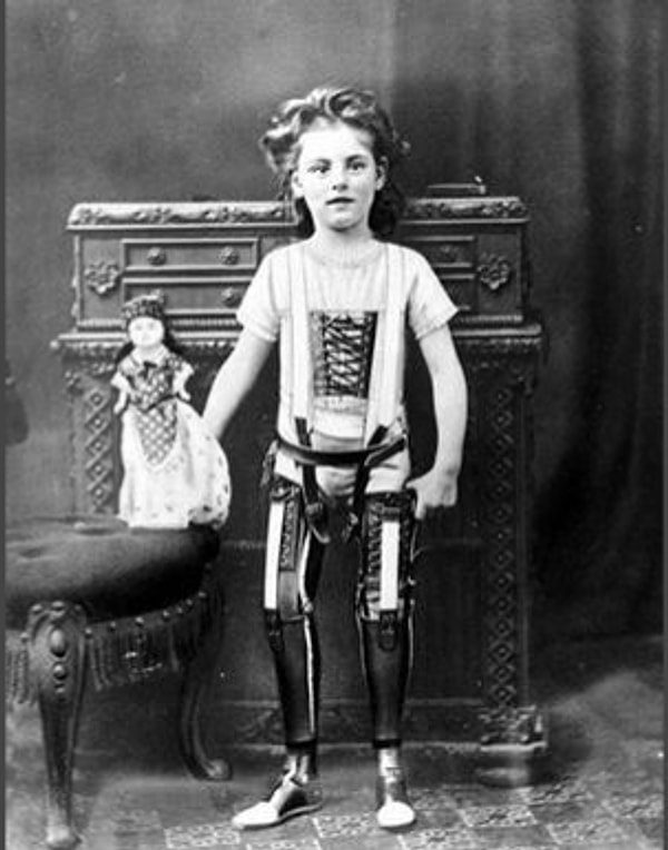 21. Впечатляющие протезы 1890-х годов