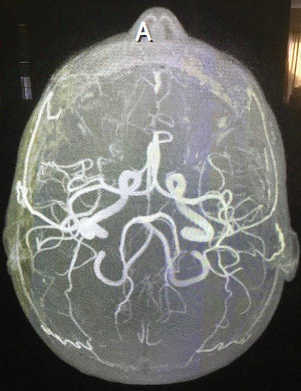 12. MRI beyindeki arterleri görmemizi mümkün kılıyor!