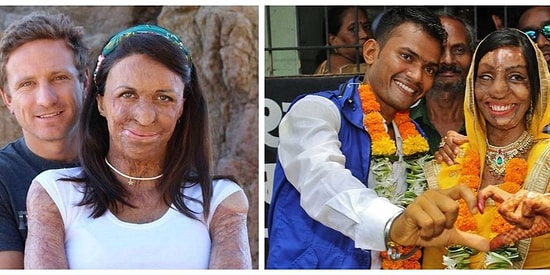 Вопреки всему: Девушки, потерявшие лицо, но сумевшие найти любовь