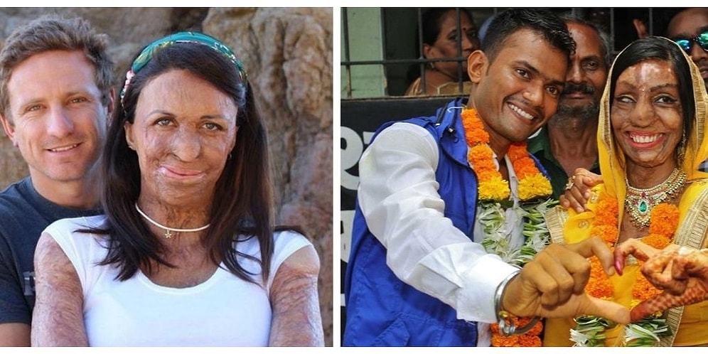 Вопреки всему: Девушки, потерявшие лицо, но сумевшие найти любовь