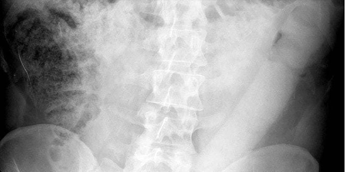 Rektumunda Bulunan 60 Santimetrelik Yapay Penisle Bir Günün Sonunda Hastanelik Oldu!