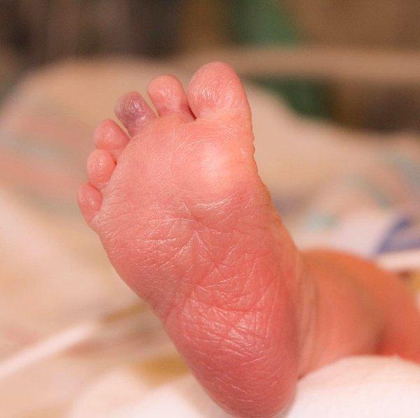5. Bu bebiş altışar ayak parmağıyla doğmuş!