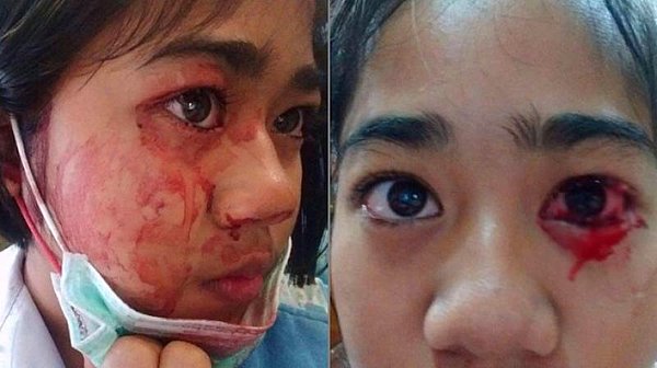 Geeta ile benzer semptomlar gösteren bir başka vaka ise henüz yedi yaşındayken hematidrosis teşhisi konulan Taylandlı Phakamad Sangchai...