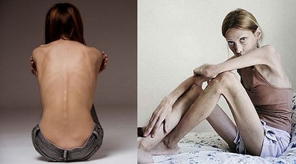 11. Отличие анорексии от булимии