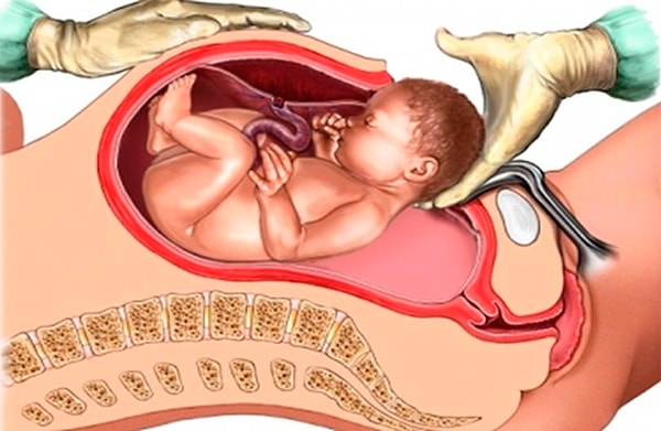 Миф 5: Кесарево сечение очень опасно