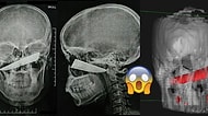 Kavga Sırasında Kafasından Bıçaklanıp Fark Etmeyen Adamın Tüyler Ürpertici Röntgen Görüntüleri