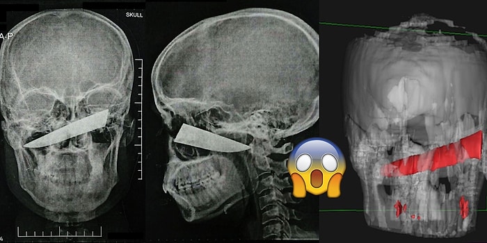 Kavga Sırasında Kafasından Bıçaklanıp Fark Etmeyen Adamın Tüyler Ürpertici Röntgen Görüntüleri