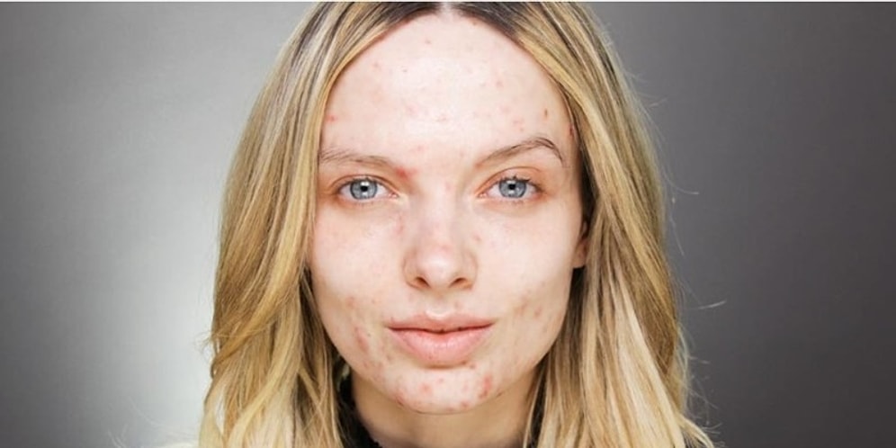 Aknelere Özgürlük: Instagram'ın Yeni Modası Cilt Kusurlarını Çekinmeden Sergilemek!