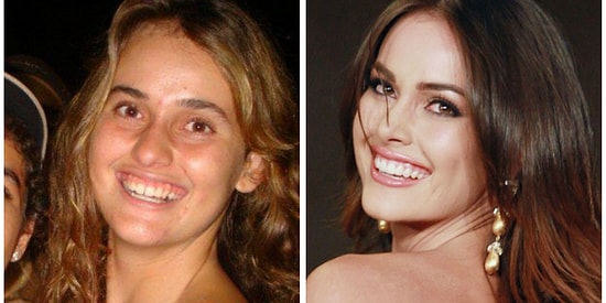 Dünyadan Örneklerle Güzellik Yarışmalarının Estetik Operasyonlara Olan Bakış Açısı