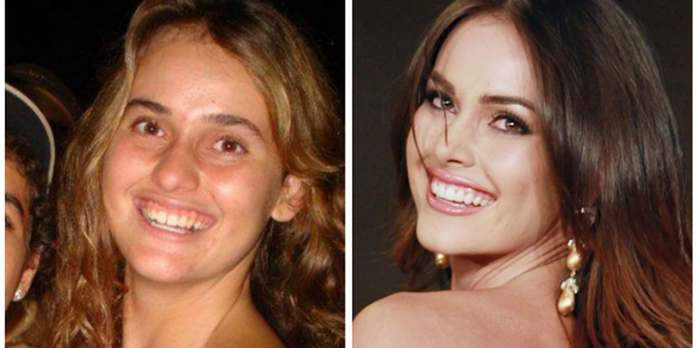 Dünyadan Örneklerle Güzellik Yarışmalarının Estetik Operasyonlara Olan Bakış Açısı