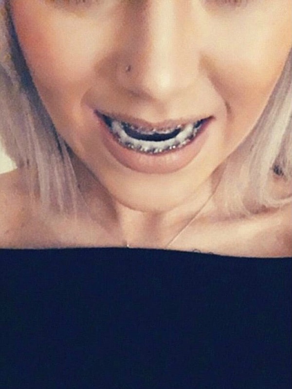 Впервые о проблемах Лулу стало известно, когда девочке было 13 лет, но ее ортодонт решил подождать, пока ей не исполнится 17 лет.