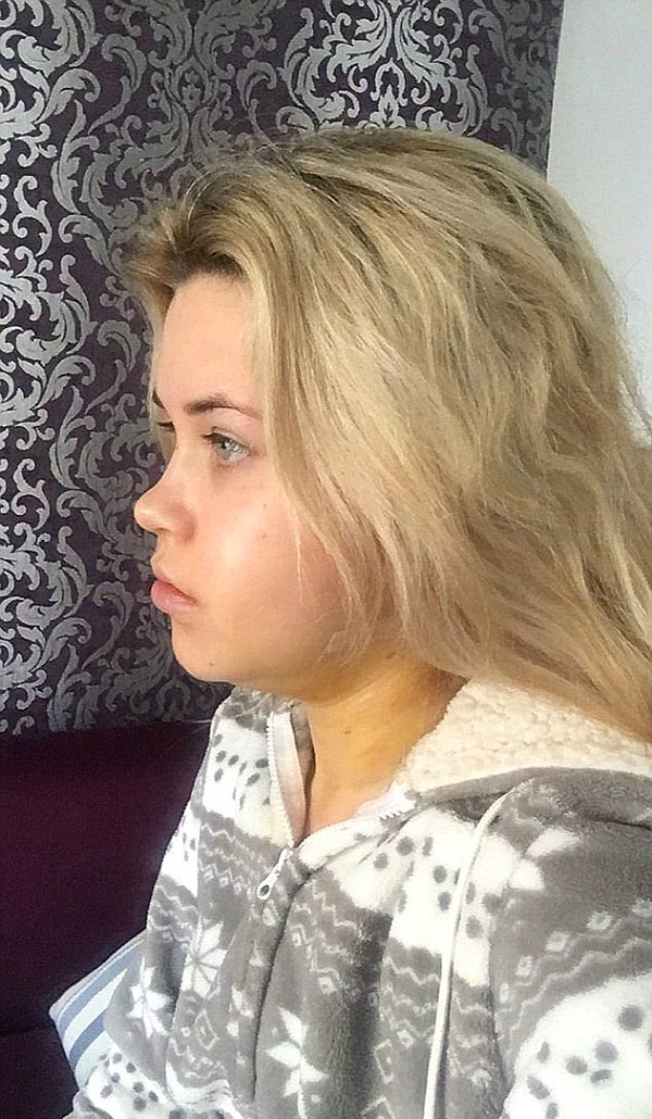 Даже после операции Лулу должна была все еще носить брекеты, и она не полностью понимала, насколько изменилась ее внешность, до тех пор, пока их не сняли.