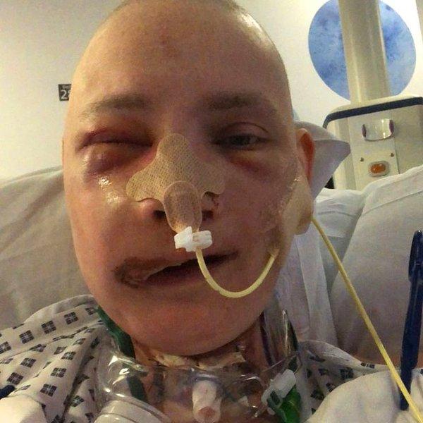 Kemik kanseri teşhisi konulan Jen Taylor, yüzü yeniden yapılandırılmadan önce üst çenesinin, yanaklarının, göz yuvalarının ve kafa tasına bağlı neredeyse her bölgenin alındığı bir ameliyat geçirmiş.
