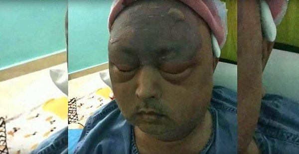 Hızla hastaneye yetiştirilen Tariq Kushroo, neyse ki enfeksiyonu atlatmış ama acemice yapılan operasyondan ötürü sağ gözü alınmak zorunda kaldı!