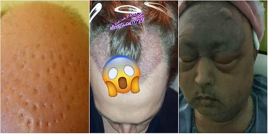 Bir Daha Düşünün! Saç Ektirme Operasyonu Yaptıranların Başına Gelen Kabus Gibi Olaylar