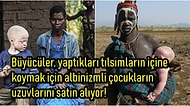 Afrika'da Lanetli Olduklarına İnanılan ve Uzuvları Kesilerek Yüksek Meblağlara Satılan Albinizmli Çocuklar!