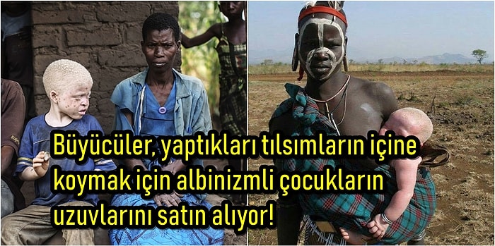 Afrika'da Lanetli Olduklarına İnanılan ve Uzuvları Kesilerek Yüksek Meblağlara Satılan Albinizmli Çocuklar!