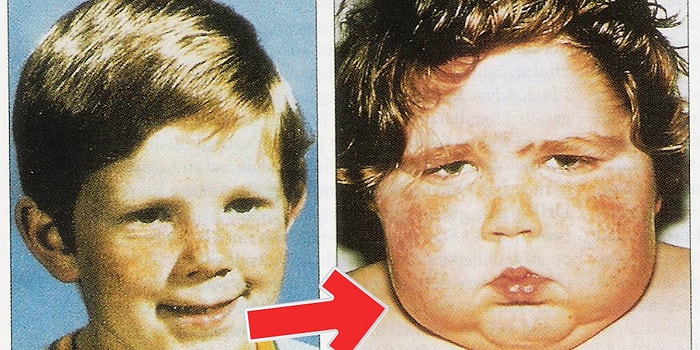 Aman Dikkat! Cushing Sendromu Hakkında Bilmeniz Gerekenler