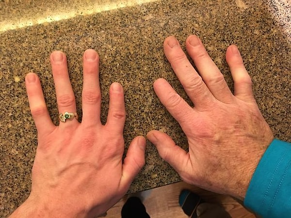 11. «Мой отец потерял фалангу указательного пальца в 10 лет, а мой указательный палец короче других с рождения»