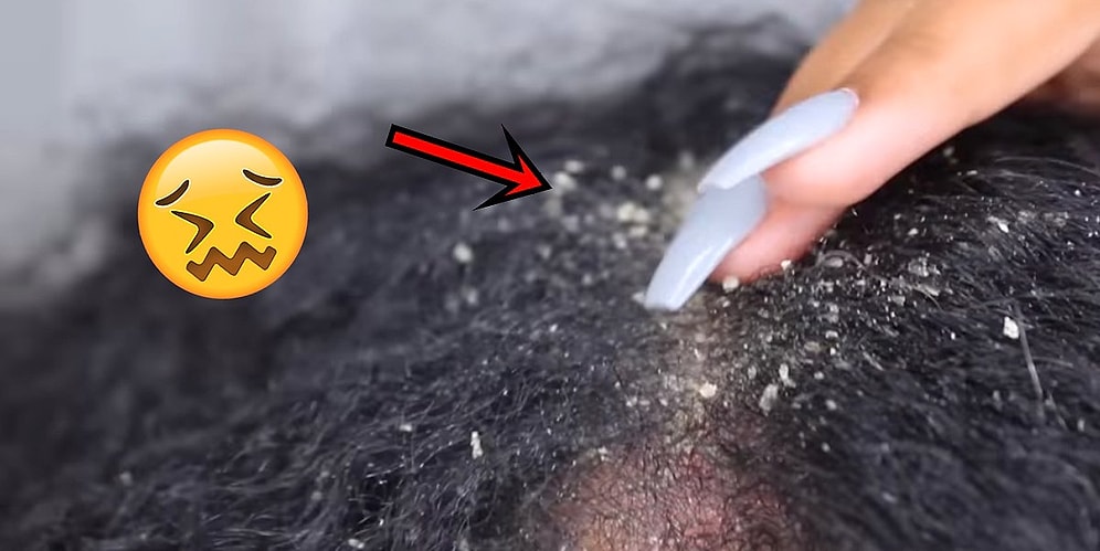 Просмотры на Ютуб зашкаливают: новый тренд после прилюдного выдавливания прыщей - прилюдная ликвидация перхоти