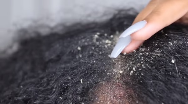 Но и это еще не все. Британские дерматологи настойчиво просят не совершать подобных действий, полагая, что такие манипуляции могут нанести серьезные вред коже головы и даже стать причиной обострения.