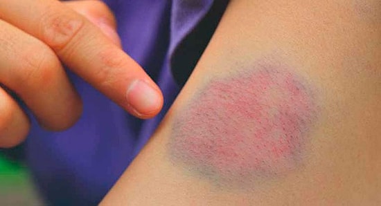 Vücuttaki Morluklar Neden Ve Nasıl Oluşur?