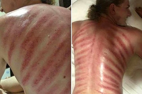 Этот удивительный остров Бали: спина туриста превратилась в паханое поле после массажа, высвобождающего "красного дракона"