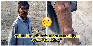 Tüm Vücudu Tümörle Kaplı Olduğu İçin Hayatı Zindan Olan Pakistanlı Adamın Yürek Burkan Hikayesi