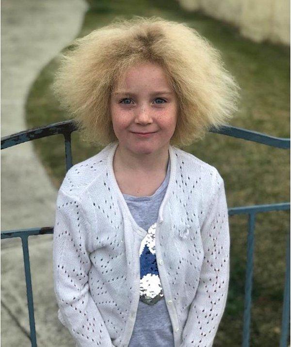 1. Shilah Madison'a taranamayan saç sendromundan ötürü "Einstein saçlı kız" adı veriliyor.
