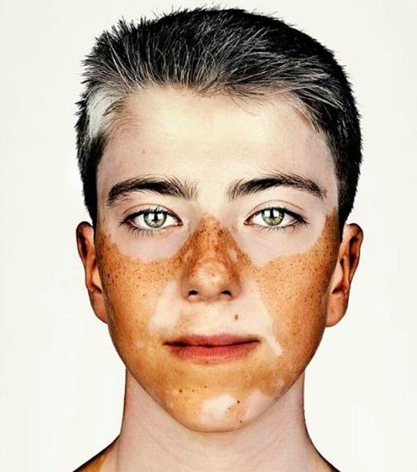 2. 13 yaşındaki James Stewart'ta akderi olarak da bilinen vitiligo rahatsızlığı var.